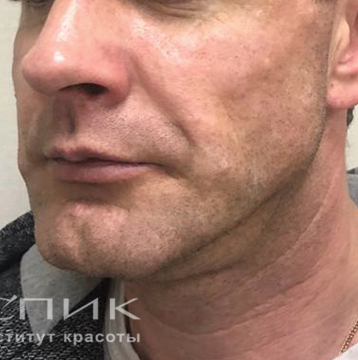 Контурная пластика лица, доктор Бейнешев Р. С.
