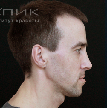 Контурная пластика щечно-скуловой области, доктор Федоров Д. В.