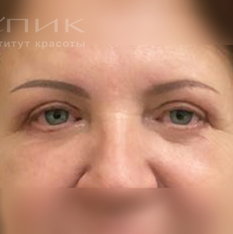 Блефаропластика