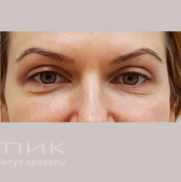Блефаропластика