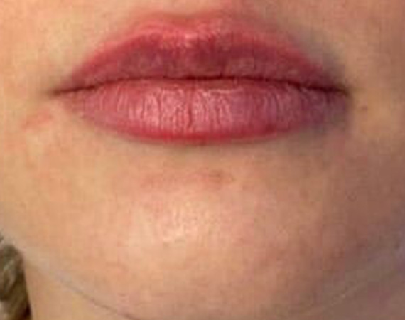 Коррекция губ, препарат Juvederm Ultra Smile, доктор Фёдоров Д. В.