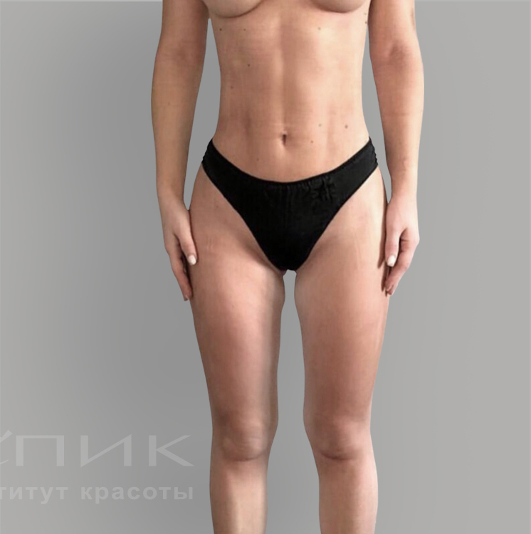Липофилинг, доктор Нугаев Т. Ш.