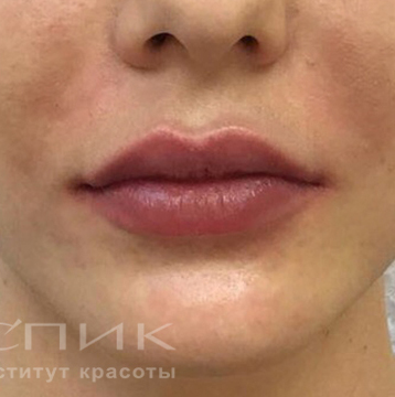 Контурная пластика губ, доктор Федоров Д. В.