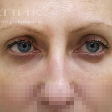 Блефаропластика