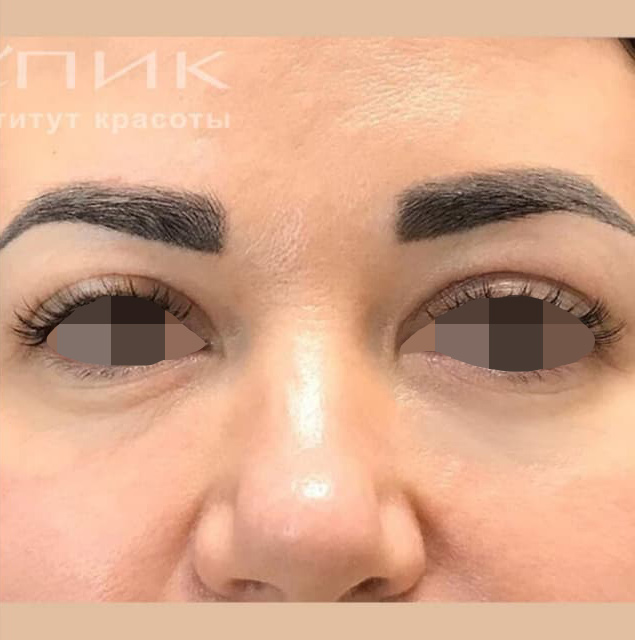 Блефаропластика, доктор Абозин М. В.
