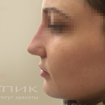 Контурная пластика, доктор Терентьева Е.В. (Масленникова Е.В)