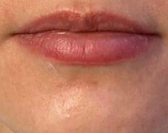Коррекция губ, препарат Juvederm Ultra Smile, доктор Фёдоров Д. В.