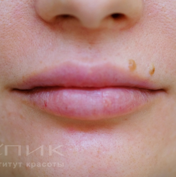 Контурная пластика лица, доктор Федоров Д. В.