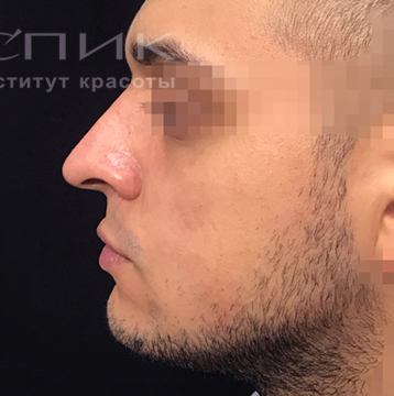 Контурная пластика носа, подбородка, углов нижней челюсти и скуловой области, доктор Федоров Д. В.