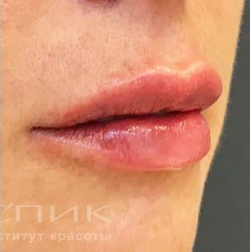 Контурная пластика губ, доктор Федоров Д. В.