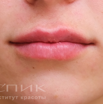 Контурная пластика лица, доктор Федоров Д. В.