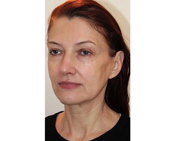 Эндоскопический лифтинг, доктор Васильев Д.О.