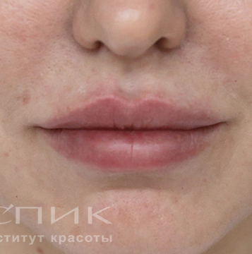 Контурная пластика лица, доктор Скибан Ю. А.