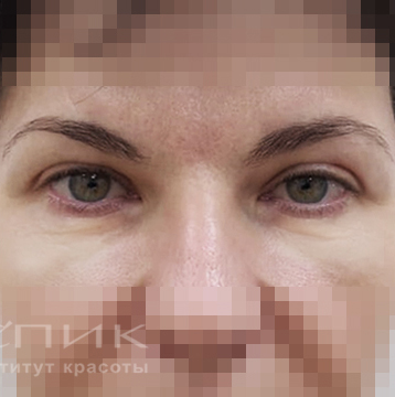 Блефаропластика