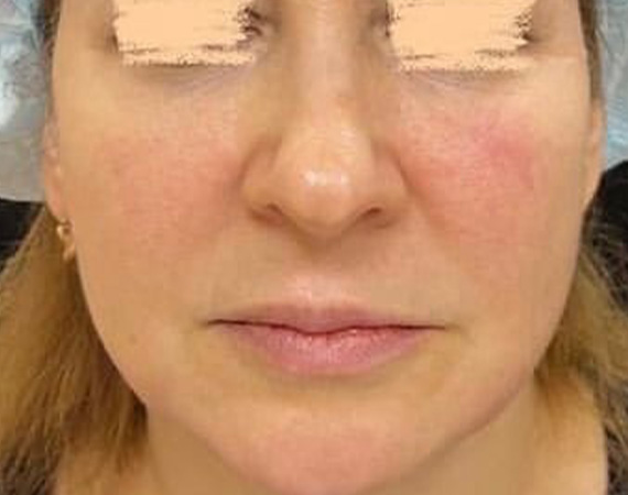 Коррекция нижней трети лица препаратами Juvederm Voluma и Juvederm Volux