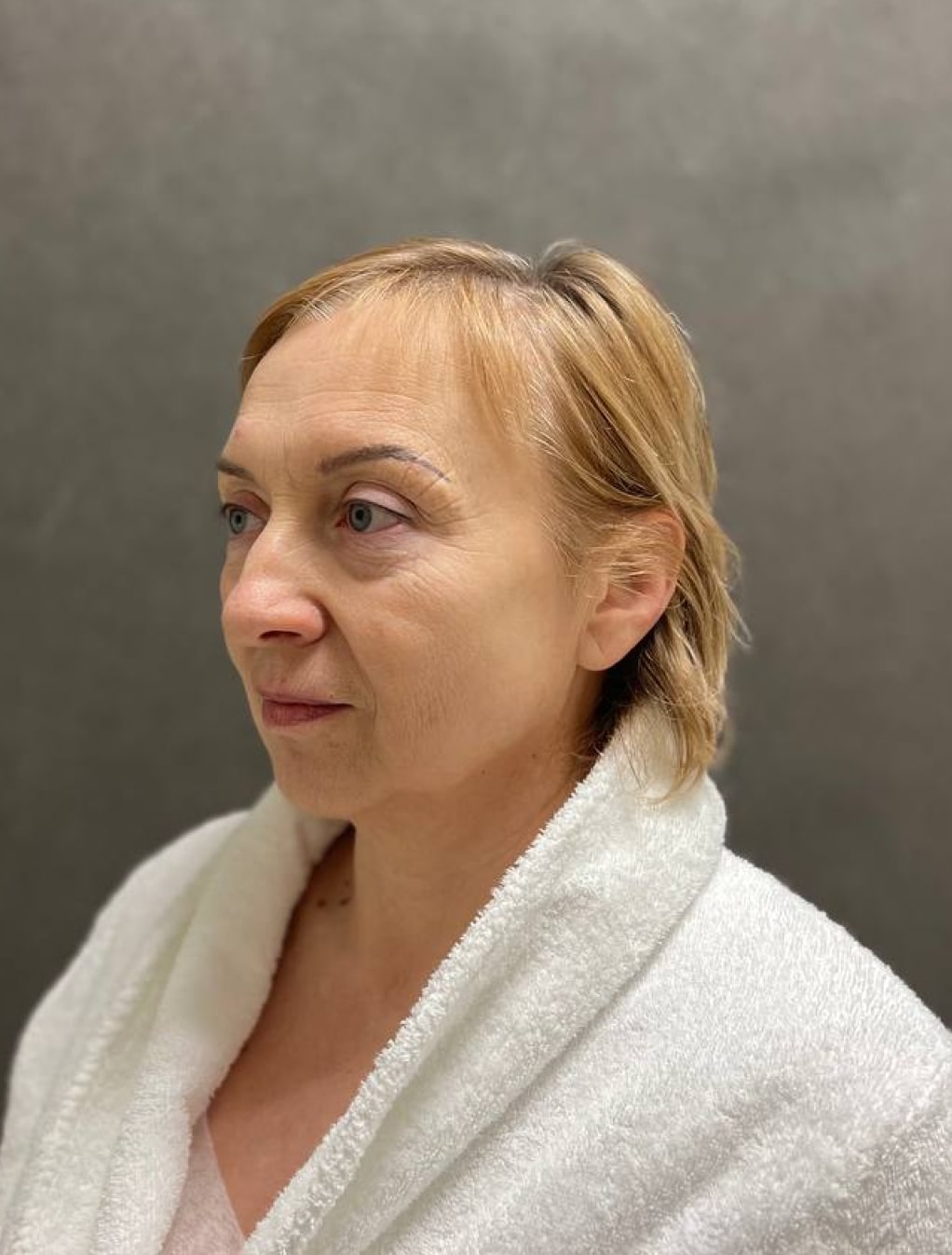 Блефаропластика, доктор Крылов М.С