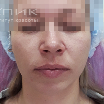 Контурная пластика лица, доктор Скибан Ю. А.