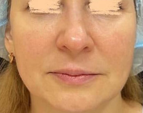 Коррекция нижней трети лица препаратами Juvederm Voluma и Juvederm Volux