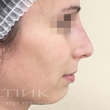 Контурная пластика носа, доктор Федоров Д.В.