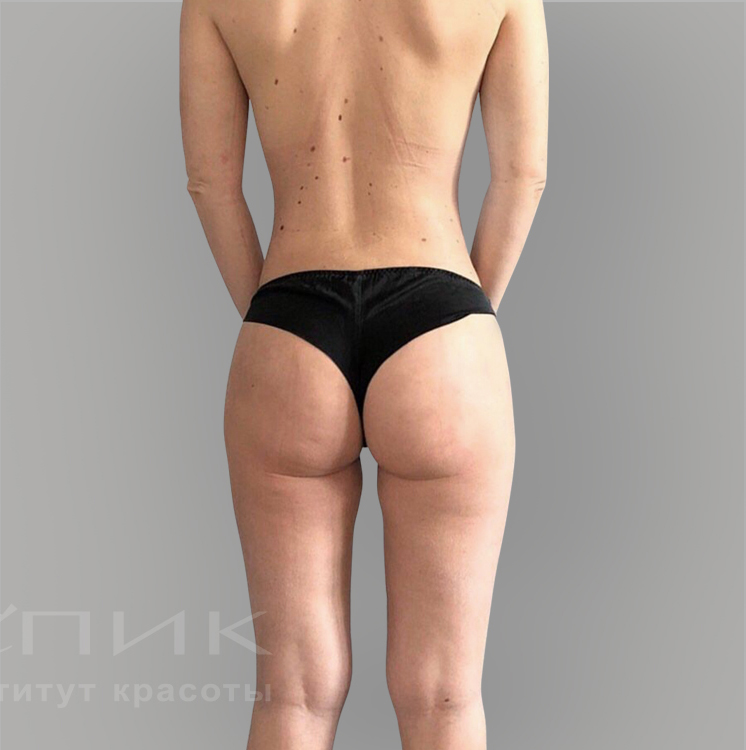 Липофилинг, доктор Нугаев Т. Ш.