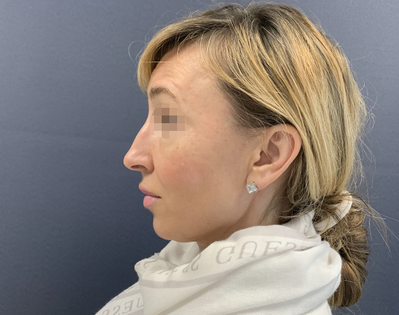 Риносептопластика, доктор Арутюнян Г.Г.